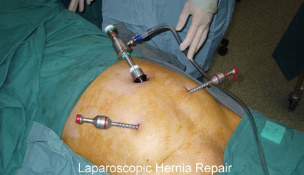 Laparoscopic hernia repair cost treatment in India